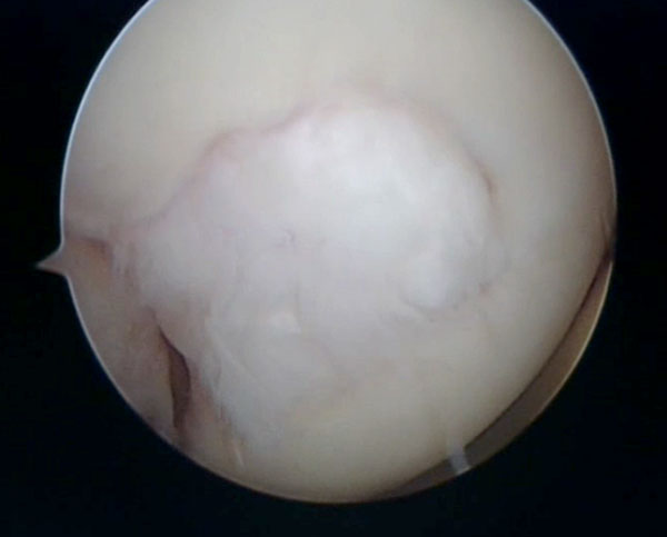 image Defect treated with micro fracture seen at six month showing fibrocartilage has filled in the defect. treated by Mr. Aslam Mohammed.high level atheltics   knee injuries